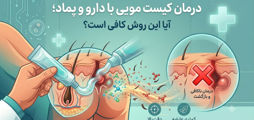 درمان کیست مویی با دارو و پماد؛ آیا این روش کافی است؟